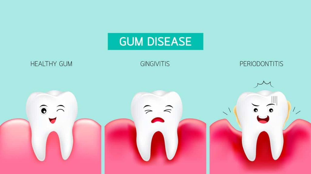 can gum disease kill you